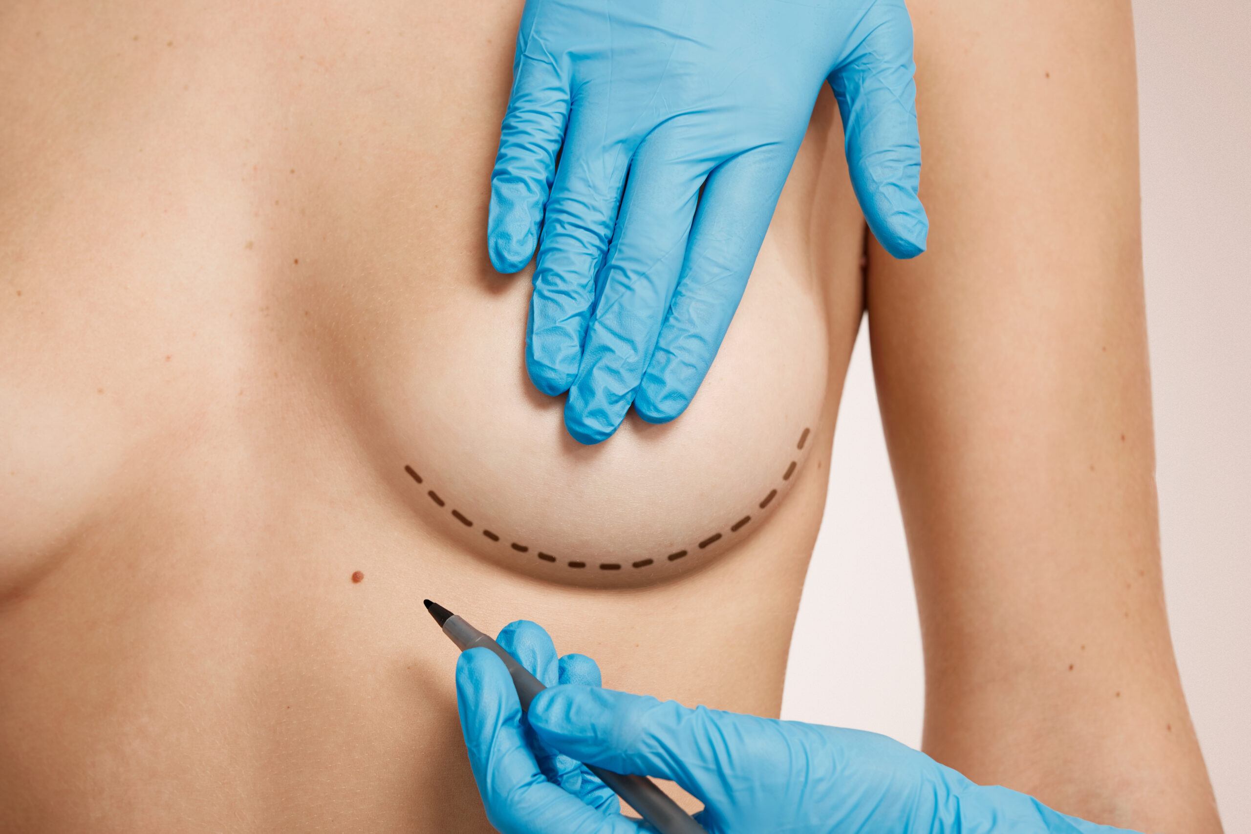beautiful woman with plastic surgery, depiction, plastic surgeon hands. cosmetic surgery concept